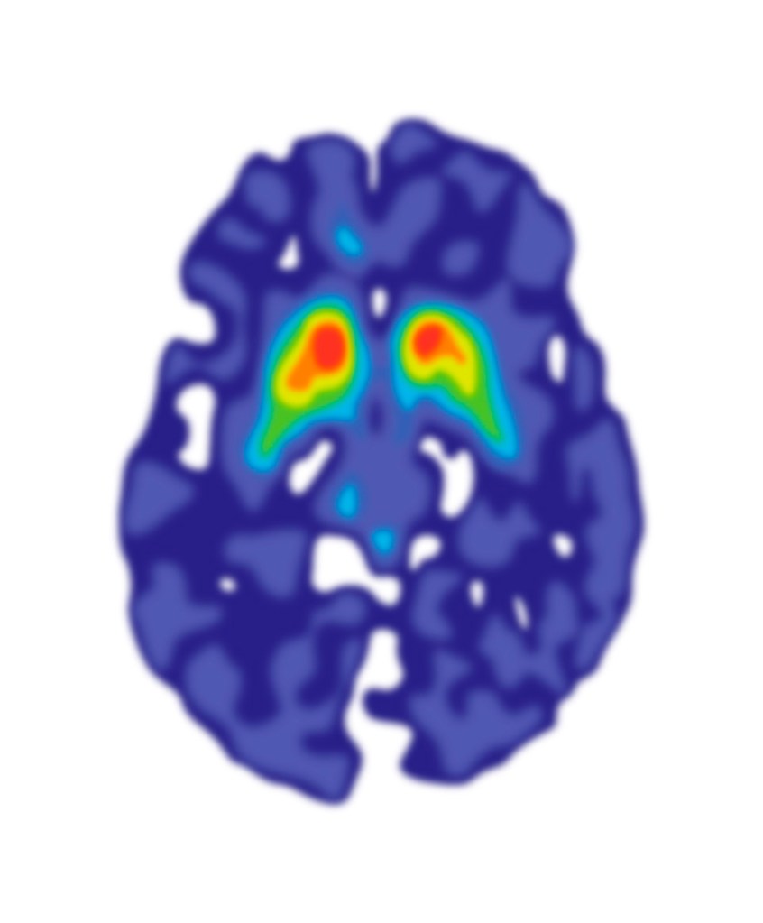 Illustration of an FDOPA PET scan with a rainbow colour scheme