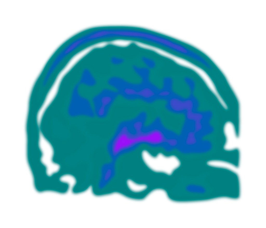 Illustration of an FDOPA PET scan with a blue-green colour scheme