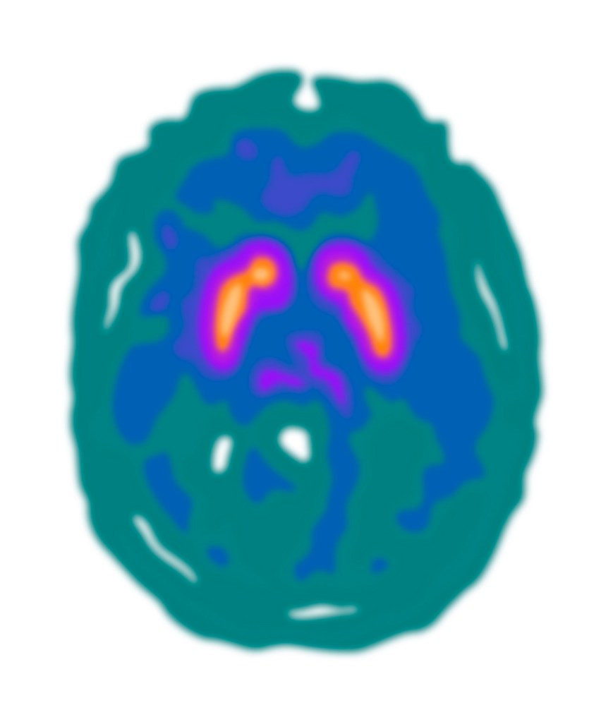 Illustration of an FDOPA PET scan with a blue-green colour scheme
